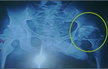 necrosis-of-joint